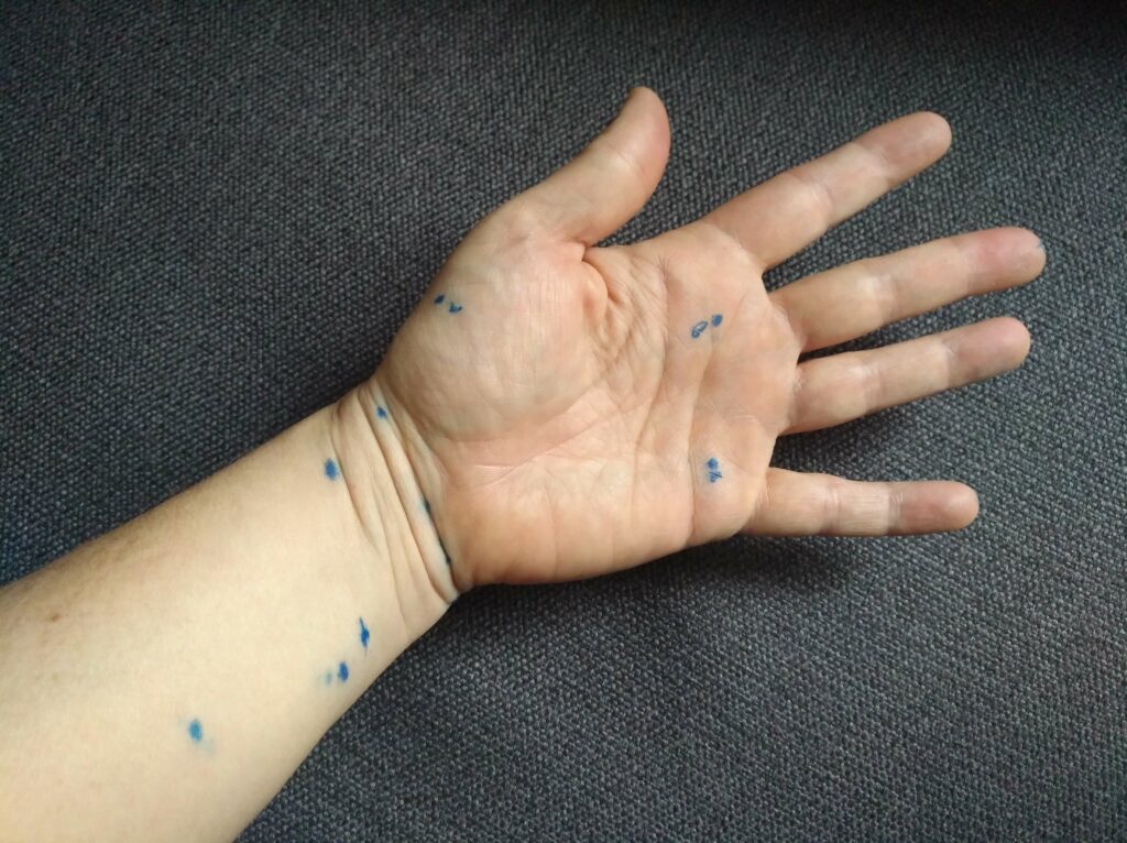 eine Hand mit aufgemalten Akupunkturpunkten